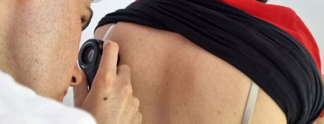 Besplatni dermatološki pregledi u Gospiću